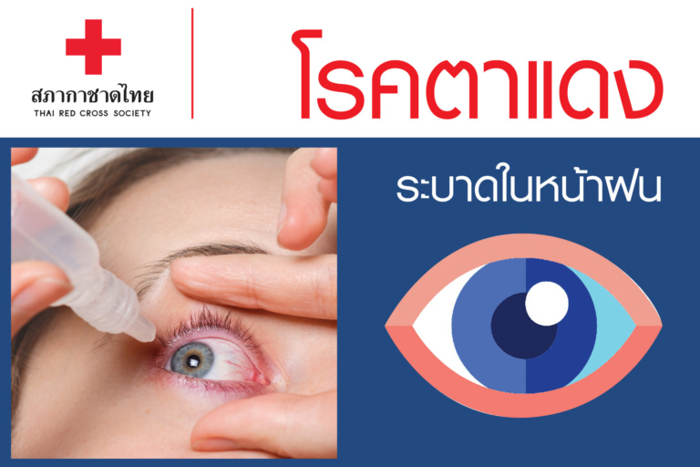 หน้าเปิด – โรคตาแดงระบาดในหน้าฝน-01