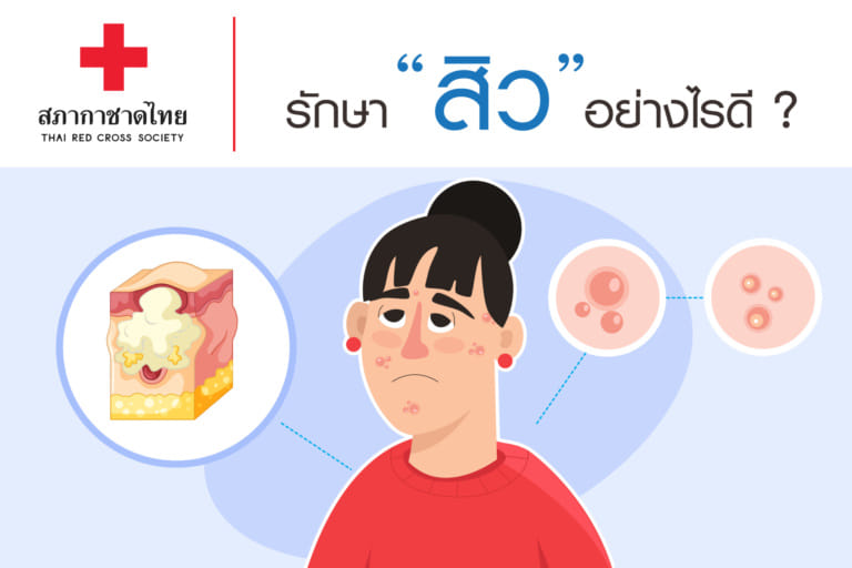 หน้าเปิดบทความ – รักษาสิวอย่างไรดี-01
