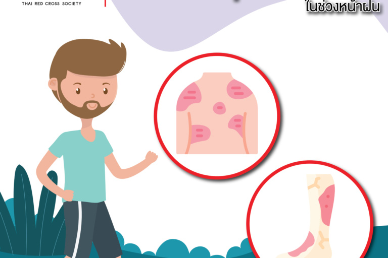 หน้าเปิด – ฮ่องกงฟุตโรคที่ต้องระวังในช่วง