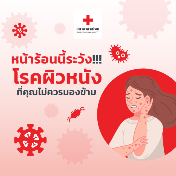 รูปภาพหน้าร้อนนี้ระวังโรคผิวหนังที่คุณไม่ควรมองข้าม